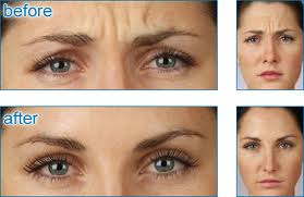 Botox