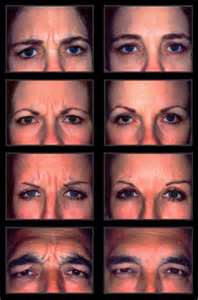 Botox