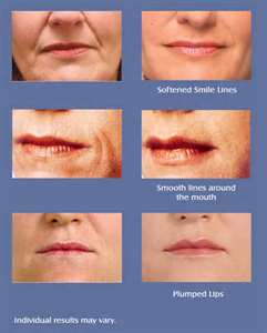 Juvederm